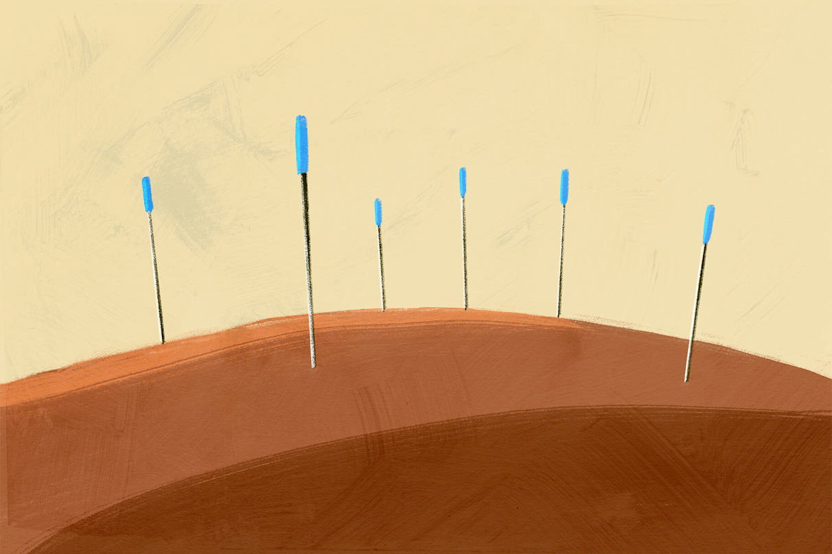 What Are Trigger Points — And How Can They Be Treated?