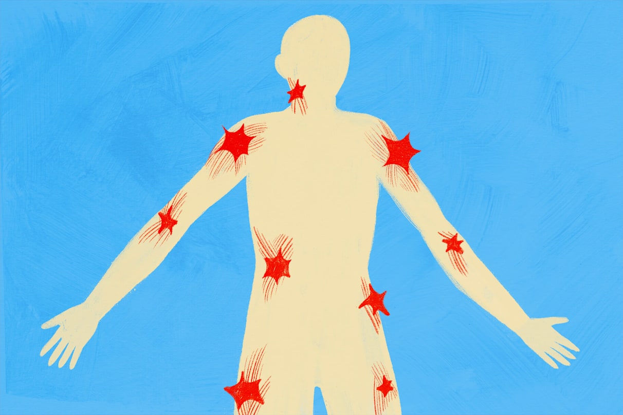 What Are Trigger Points — And How Can They Be Treated?