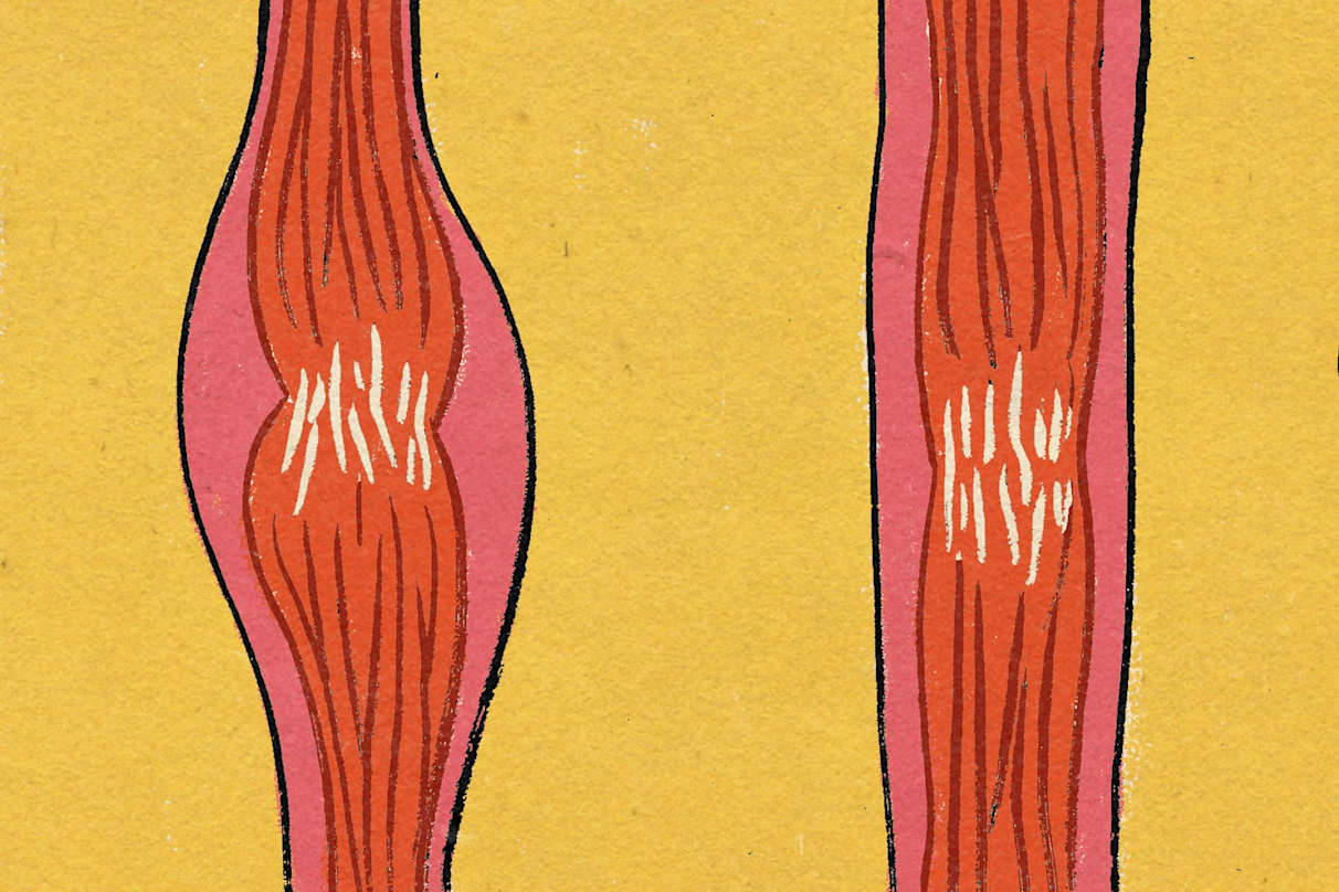 Tendonitis vs. Tendinosis: How To Prevent and Treat Both