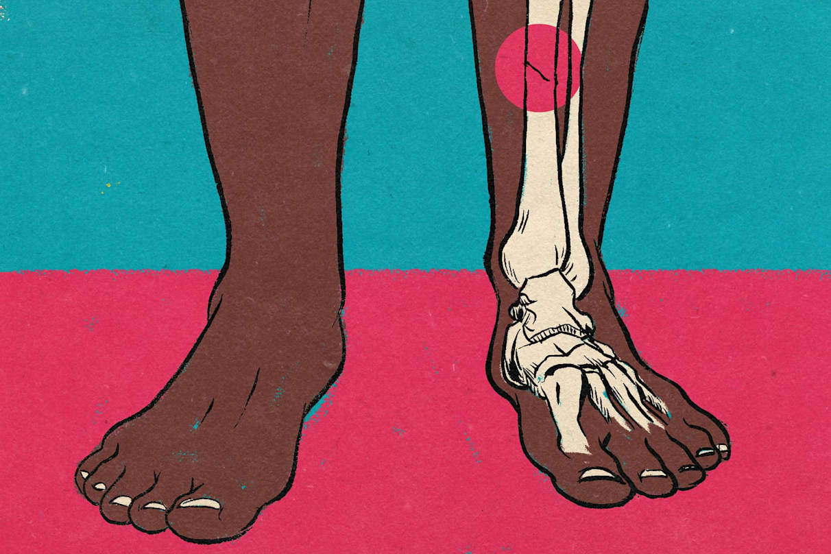 Everything You Need To Know About Stress Fractures