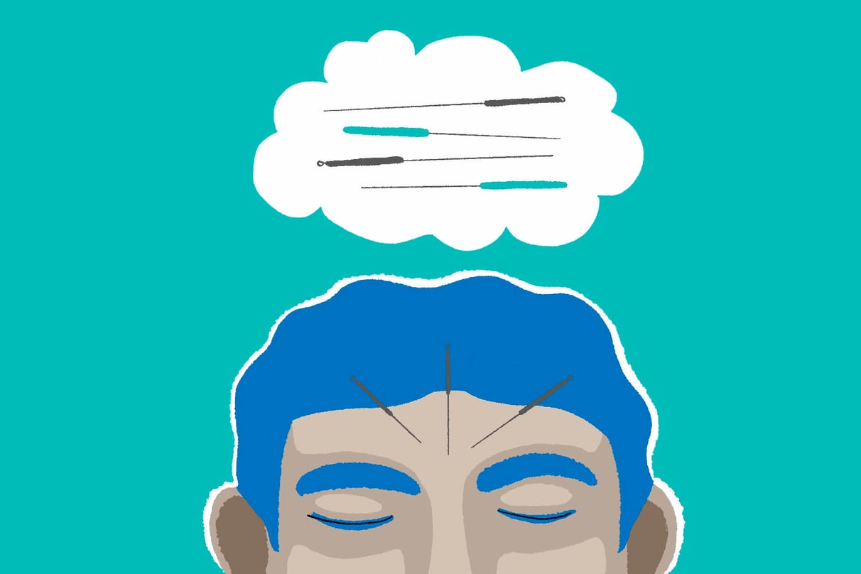 ドライニードリングとは何ですか?