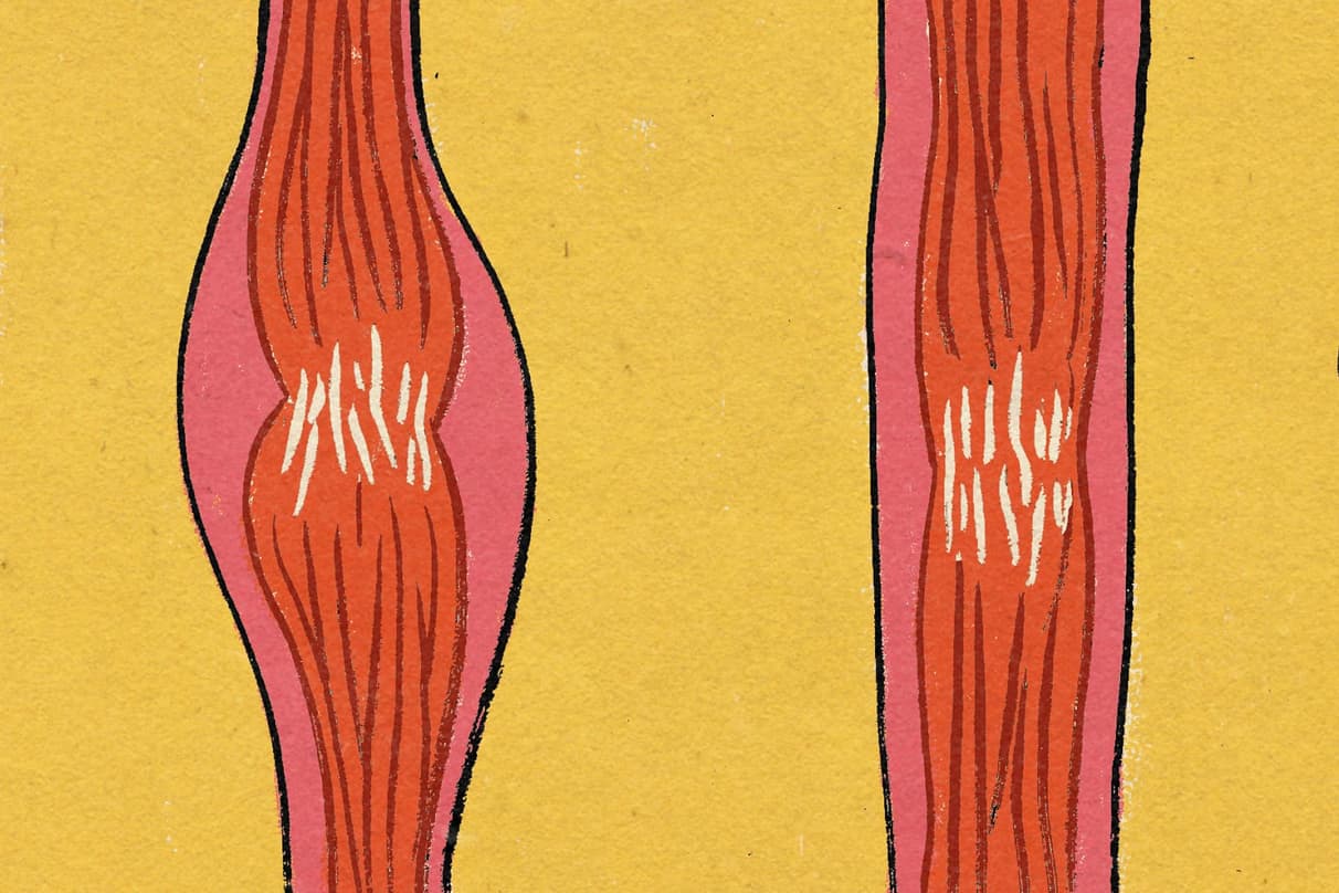 Tendinitis y tendinosis: cómo prevenirlas y tratarlas